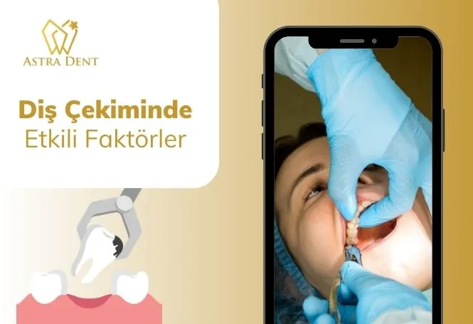 Diş Çekiminde Etkili Faktörler - Astradentclinic com