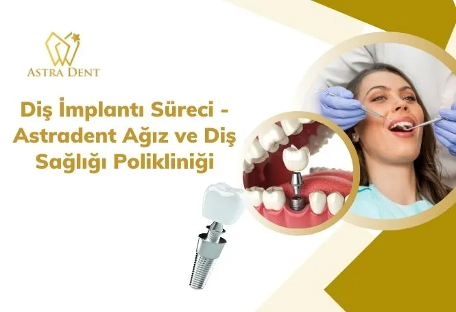 Diş İmplantı Süreci - Astradent Ağız ve Diş Sağlığı Polikliniği - Astradentclinic com