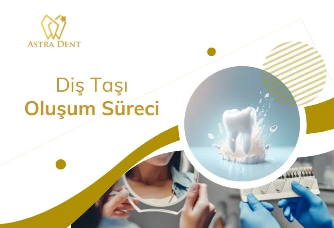 Diş Taşı Oluşum Süreci - Astradentclinic com