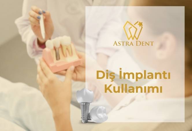 Diş İmplantı Kullanımı - Bağcılar - Astradentclinic com