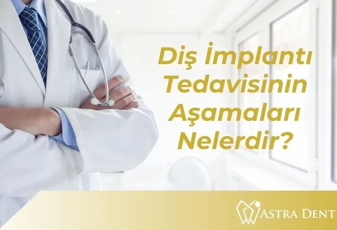 Diş İmplantı Tedavisinin Aşamaları Nelerdir - Astradentclinic com